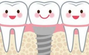 赣州烤瓷牙种植价格表