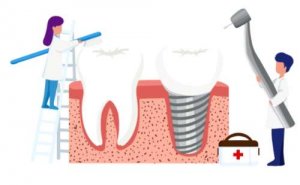 常德单颗牙种植价格展示