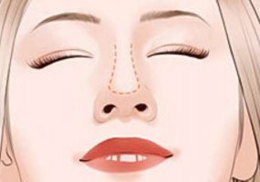 郑州天后自体脂肪隆鼻技术专业吗?隆鼻哪个医生好 郑州天后自体脂肪隆鼻技术专业吗?隆鼻哪个医生好