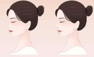 泉州三甲隆鼻医院排名,医美新人攻略