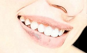 西安虎牙矫正大概需要多少钱一颗？具体价格因素如下