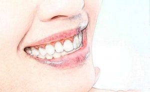 北京牙管家口腔诊所瓷贴面多少钱？1800-16800元左右，医院简介