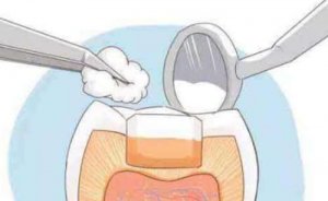 南京哪里补牙又好又便宜?好的医院公布