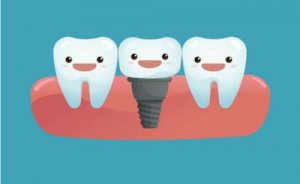 常德种植牙多少钱一颗(种植牙价格表有没有)