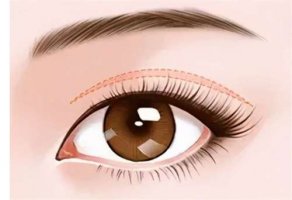 什么样的眼睛不适合做双眼皮？双眼皮整形有风险吗？