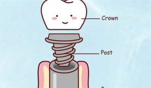 包头种植牙多少钱一颗2023年？科普小妙招奉上