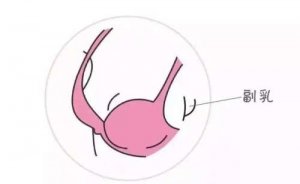 杭州去副乳哪家医院做的好？技术怎么样