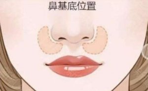 北京去鼻唇沟哪家医院做得好?top10强有没有你喜欢的 北京去鼻唇沟哪家医院做得好?top10强有没有你喜欢的