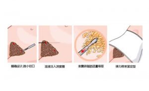 湖北省三甲吸脂医院排名,与这些有关 湖北省三甲吸脂医院排名,与这些有关