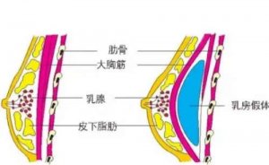 深圳硅胶隆胸医院排行榜前十强清单公示！口碑技术不错