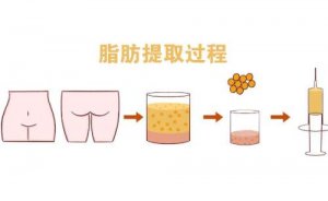 宜春三甲脂肪填充医院排名,人气实力都有 宜春三甲脂肪填充医院排名,人气实力都有