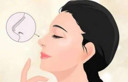 隆鼻