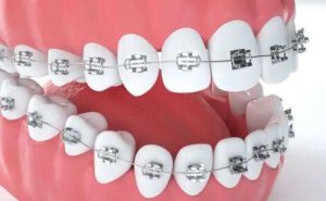 南京市第一医院进口牙套矫正实力案例&费用明细?