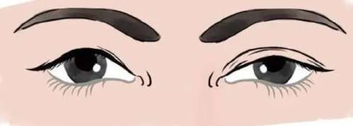 双眼皮
