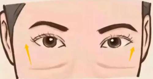 去眼袋