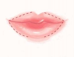 嘟嘟唇打完5天内的图片怎么样?案例前后变化大吗?戳进看 嘟嘟唇打完5天内的图片怎么样?案例前后变化大吗?戳进看