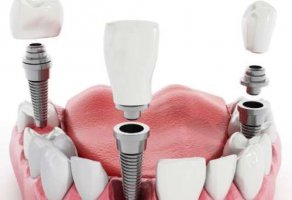 重庆大坪医院种植牙多少钱？挂号指南，种植牙收费详情精选