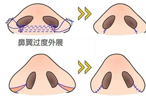 鼻翼