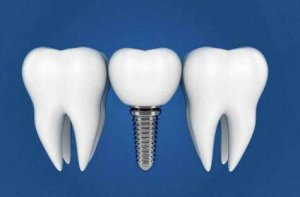 武汉市第四医院种植牙价格是多少？费用标准，医院科室资料更新