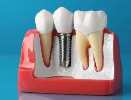 萧山人民医院种植牙多少钱？项目收费|地址路线了解