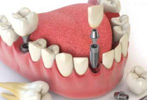 广州穗华口腔医院种植牙怎么样？技术优势查看，附医生团队实力雄厚