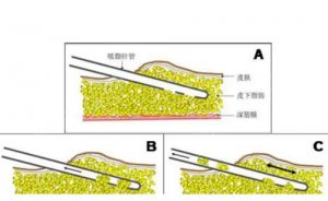 银川三甲吸脂医院排名,快快收藏起来