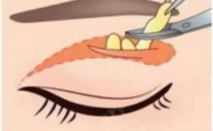 贵州省三甲双眼皮手术医院排名,审美技术好